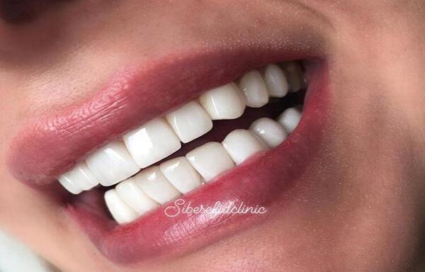 عکس دندانهای سفید