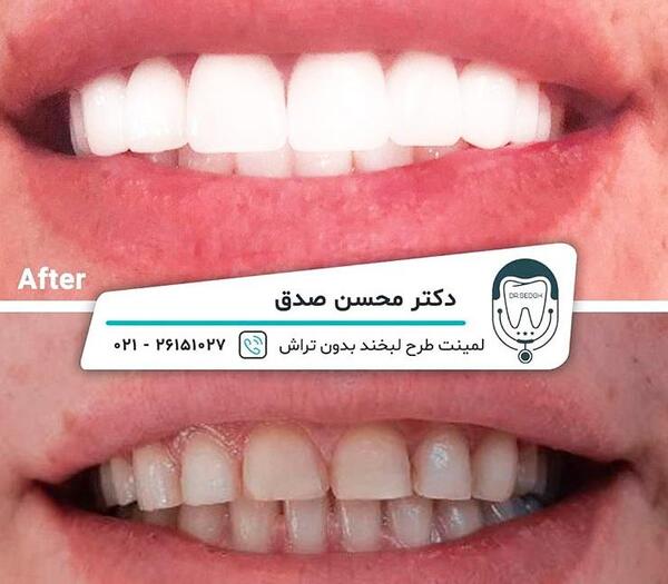 عکس دندانهای سفید
