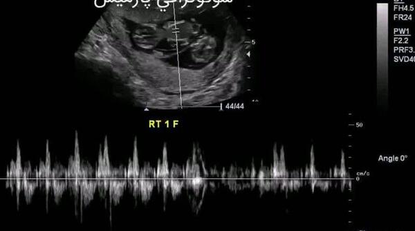 عکس قلب جنین در سونوگرافی