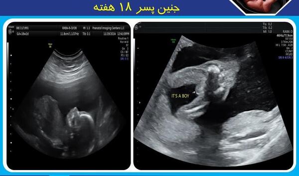 عکس جنین پسر در آنومالی