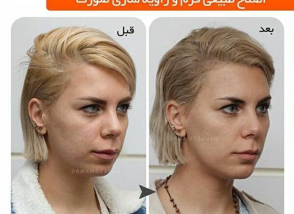 عکس قبل و بعد تزریق ژل گونه