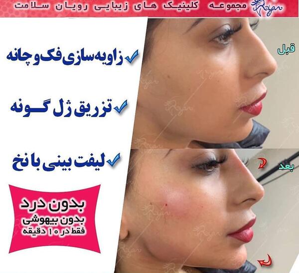 عکس قبل و بعد تزریق ژل گونه