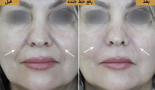 عکس قبل و بعد تزریق ژل گونه