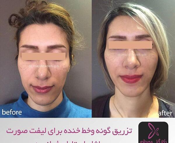 عکس قبل و بعد تزریق ژل گونه