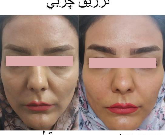 عکس قبل و بعد تزریق ژل گونه