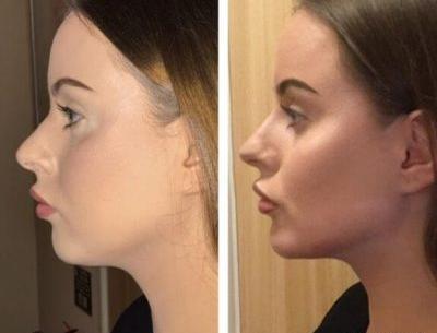 عکس قبل و بعد تزریق ژل گونه