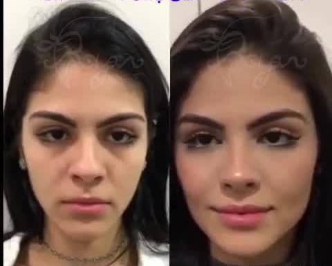 عکس قبل و بعد تزریق ژل گونه