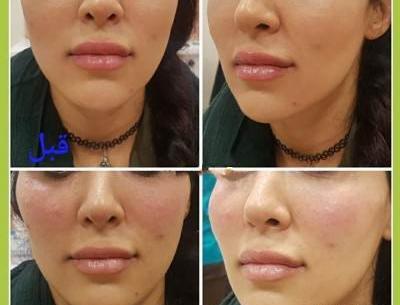 عکس قبل و بعد تزریق ژل گونه
