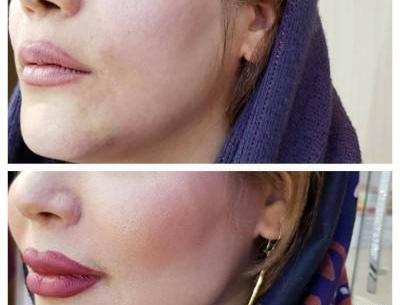 عکس قبل و بعد تزریق ژل گونه