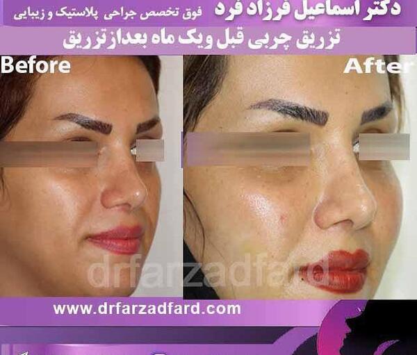 عکس قبل و بعد تزریق ژل گونه