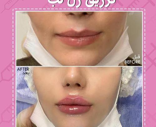 عکس قبل و بعد تزریق ژل گونه