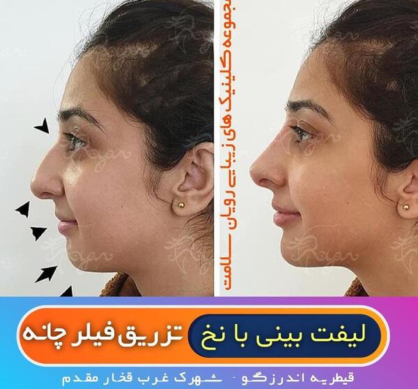 عکس قبل و بعد تزریق ژل گونه