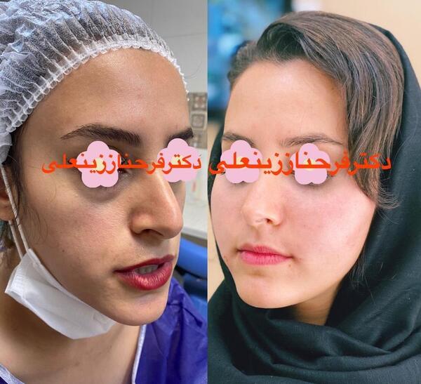 عکس قبل و بعد تزریق ژل گونه