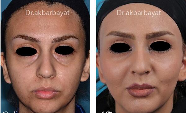 عکس قبل و بعد تزریق ژل گونه