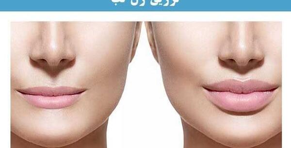 عکس قبل و بعد تزریق ژل گونه