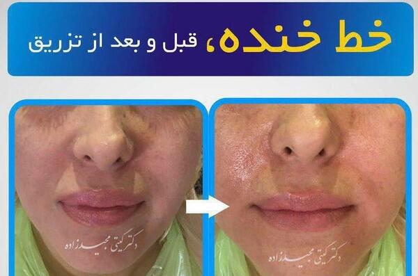 عکس قبل و بعد تزریق ژل گونه
