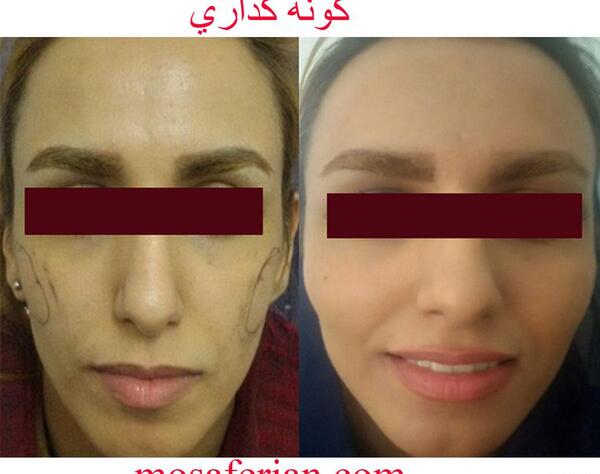 عکس قبل و بعد تزریق ژل گونه