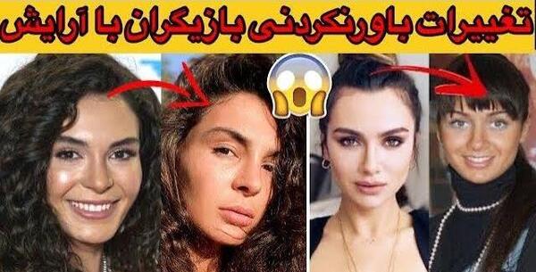 عکس ییلدیز قبل عمل
