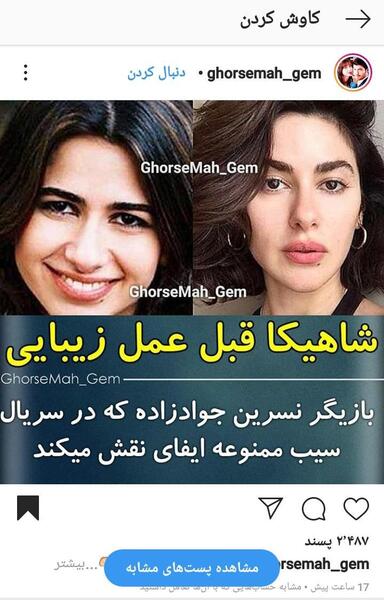 عکس ییلدیز قبل عمل