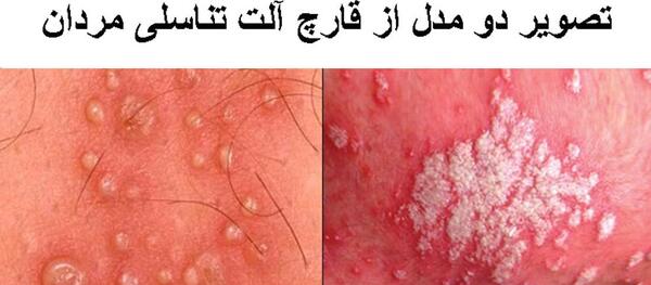 ناحیه تناسلی عکس بیماری گال