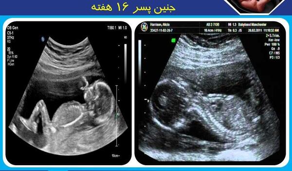 عکس جنین یازده هفته پسر