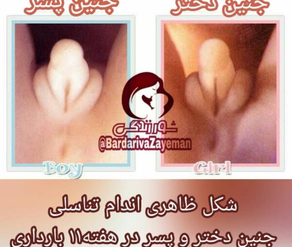 عکس جنین یازده هفته پسر
