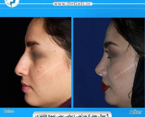 عکس فیک دخترونه دماغ عملی