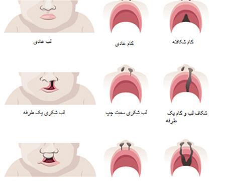 عکس بچه لب شکری