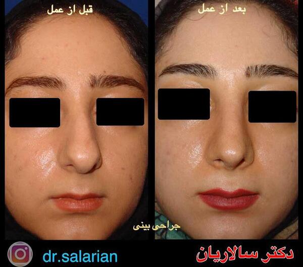 عکس قبل بعد عمل بینی