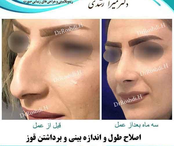 عکس قبل بعد عمل بینی