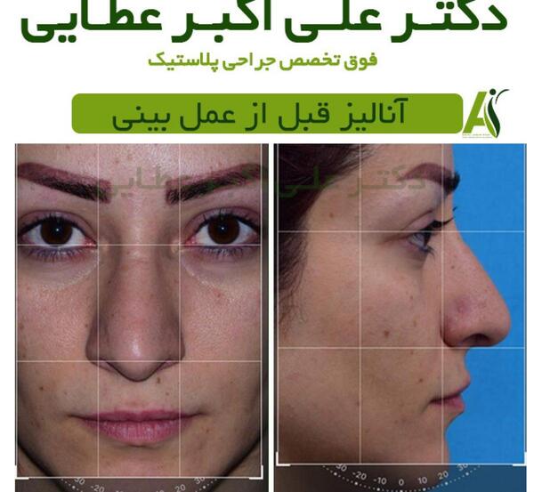 عکس قبل بعد عمل بینی