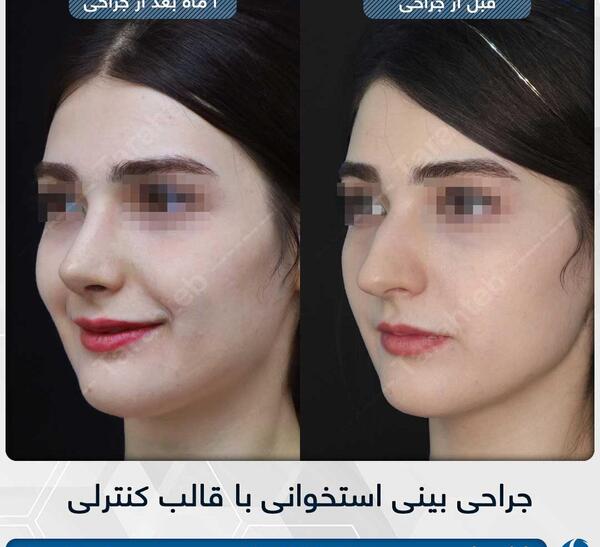 عکس قبل بعد عمل بینی