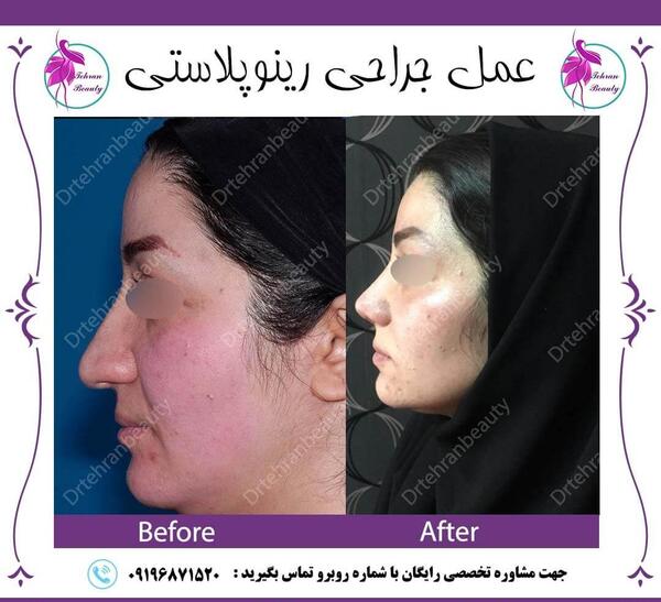 عکس قبل بعد عمل بینی