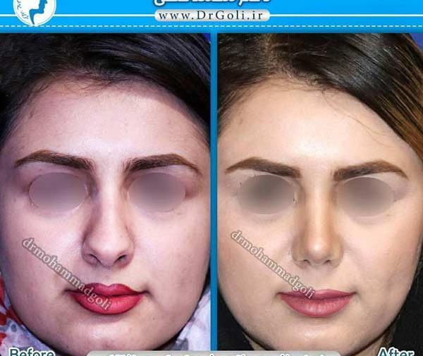 عکس قبل بعد عمل بینی