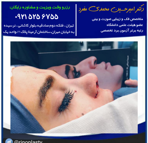 عکس کبودی بعد از عمل بینی