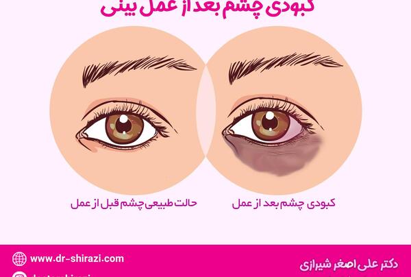 عکس کبودی بعد از عمل بینی