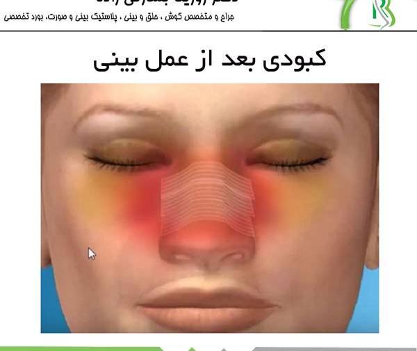 عکس کبودی بعد از عمل بینی