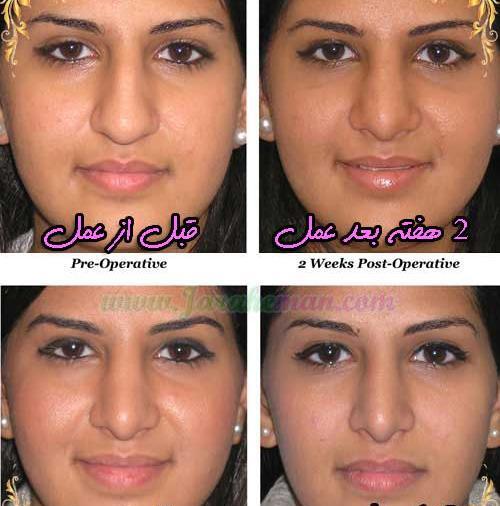 عکس کبودی بعد از عمل بینی