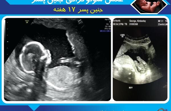 عکس جنین پسر در یازده هفتگی