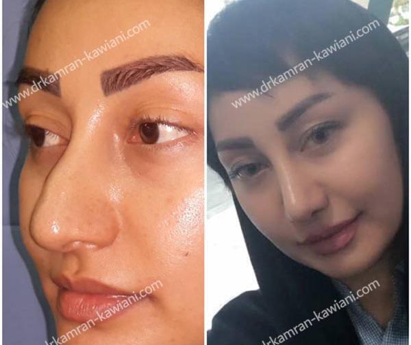 عکس فریال قبل از عمل بینی
