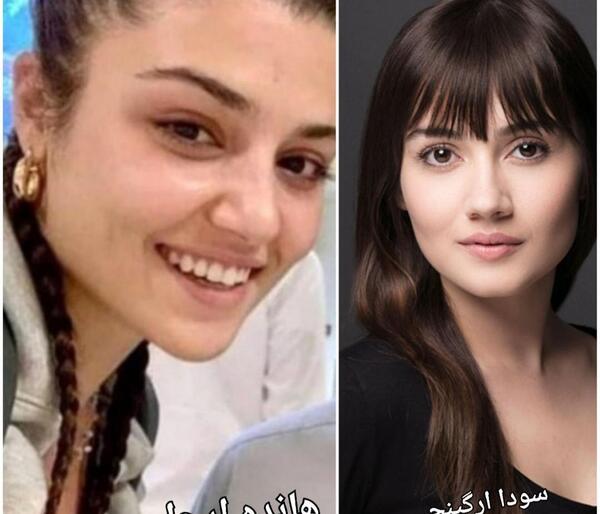 عکس قبل از عمل هانده ارچل