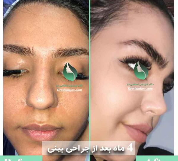 عکس جراحی بینی دکتر بهنام غفاری ساری