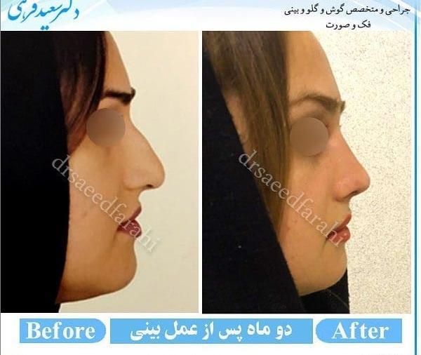 عکس جراحی بینی دکتر بهنام غفاری ساری