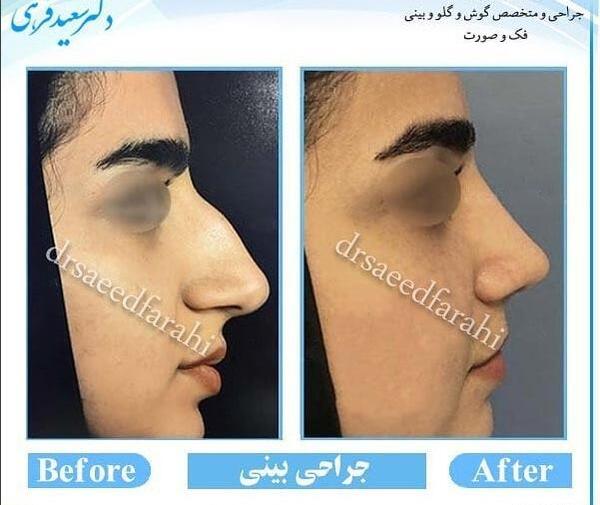 عکس جراحی بینی دکتر بهنام غفاری ساری