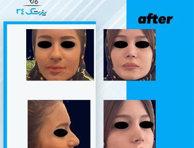 عکس جراحی بینی دکتر بهنام غفاری ساری