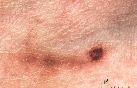 عکس بیماران مبتلا به گال