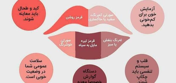 عکس کبودی لب نوزاد
