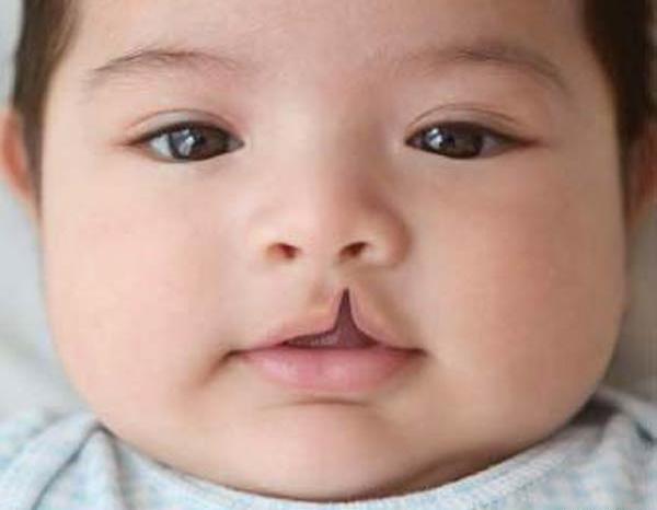 عکس کبودی لب نوزاد