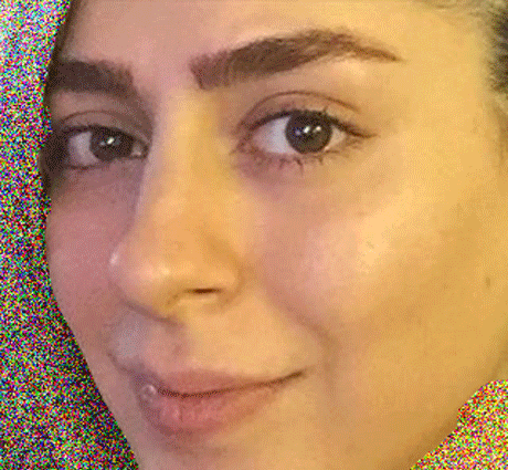 عکس سمانه پاکدل قبل عمل