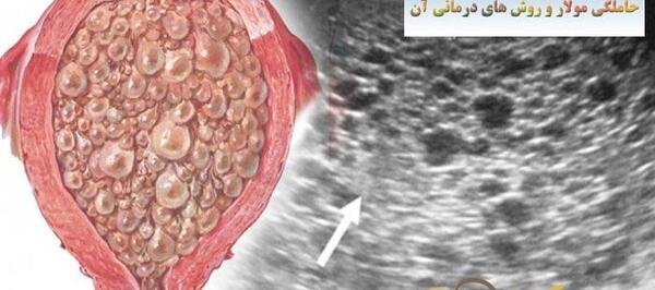 عکس بچه خوره در رحم